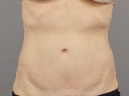Tummy Tuck Patient 01 - After 