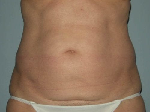 Tummy Tuck Patient 01 - Before 