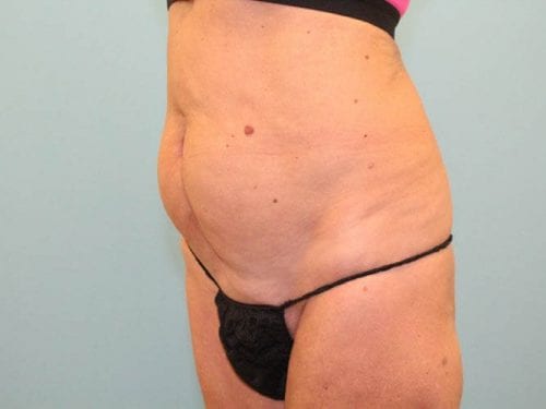 Tummy Tuck Patient 02 - Before 