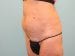 Tummy Tuck Patient 02 - Before Thumbnail 