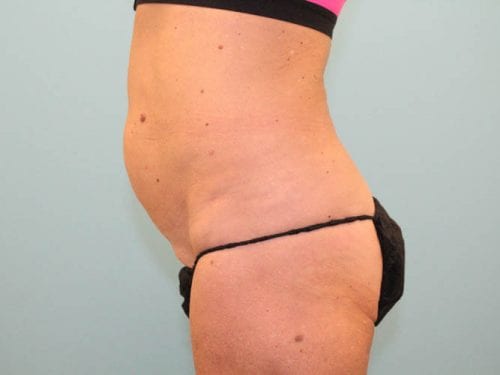 Tummy Tuck Patient 02 - Before 
