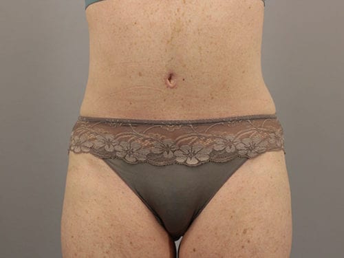 Tummy Tuck Patient 28 - After Thumbnail