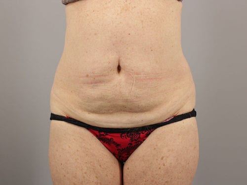 Tummy Tuck Patient 28 - Before Thumbnail