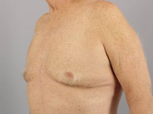 Gynecomastia Patient 01 - After 